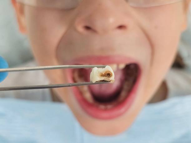 Best Emergency Dental Care for Broken or Chipped Teeth in Robinhood, MS